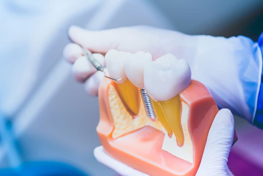 Más información sobre implantes dentales